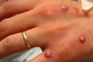 Sesau investiga 68 casos suspeitos de varÃola dos macacos em Alagoas |