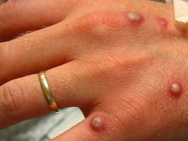 Sesau investiga 68 casos suspeitos de varíola dos macacos em Alagoas